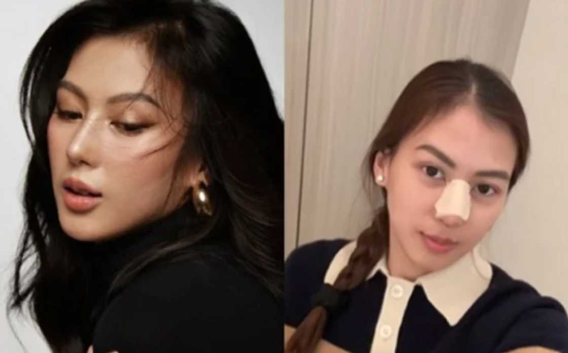 Alex Gonzaga, ipinatanggal ang nose implant: “Back to normal nose na tayo”