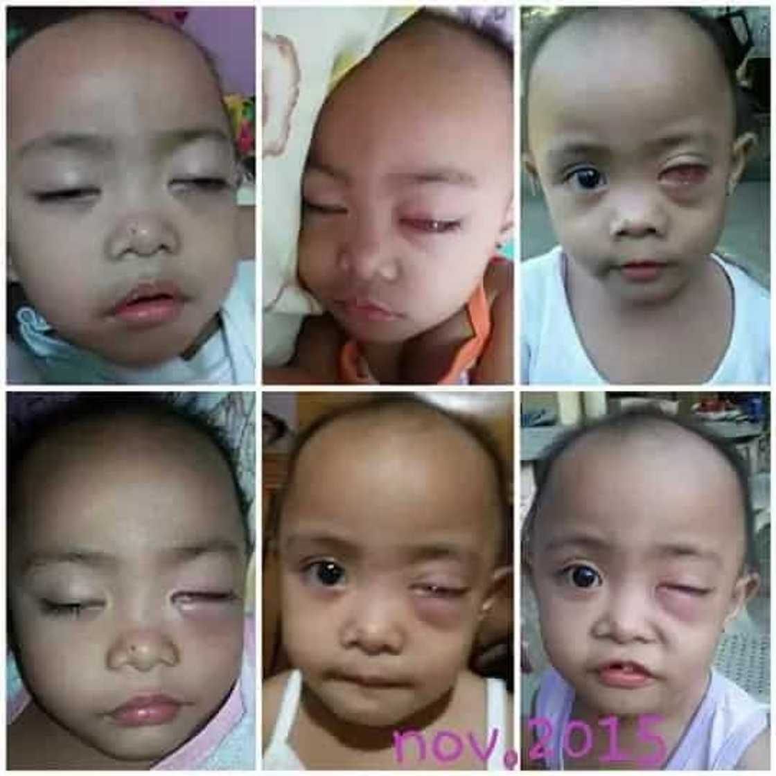2-year old fights cancer bravely 2-year old fights cancer bravely