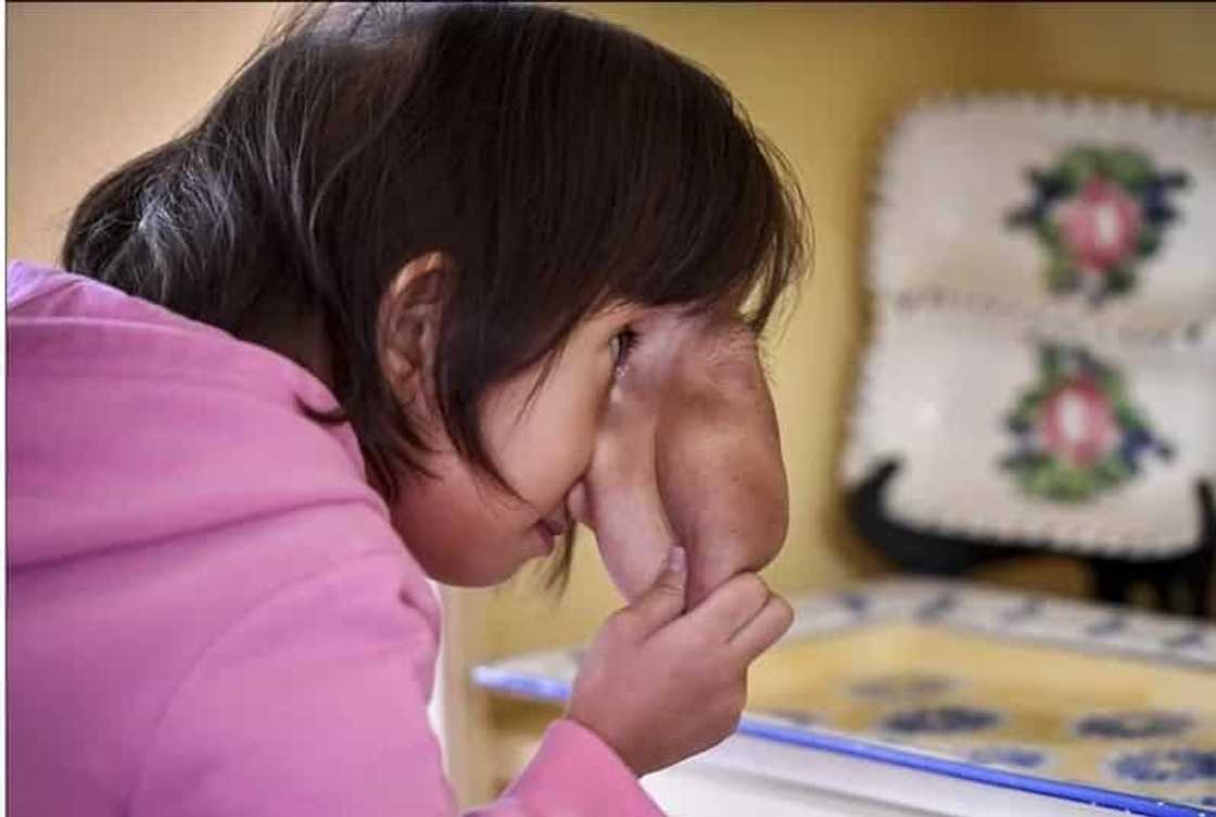 Pinay girl with deformed face gets life-changing surgery Pinay girl with deformed face gets life-changing surgery
