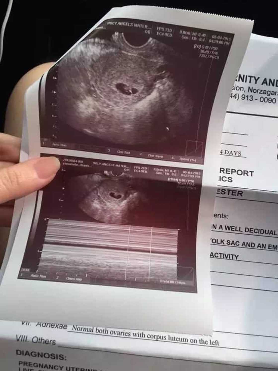 Pinay mother shares miraculous recovery of premature baby Pinay mother shares miraculous recovery of premature baby