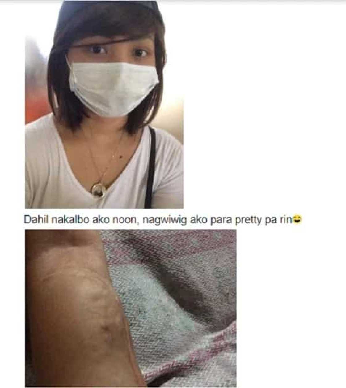 Teeange girl na naputulan ng kaliwang braso dahil sa cancer, kinakitaan parin ng positibong pananaw sa buhay Teeange girl na naputulan ng kaliwang braso dahil sa cancer, kinakitaan parin ng positibong pananaw sa buhay