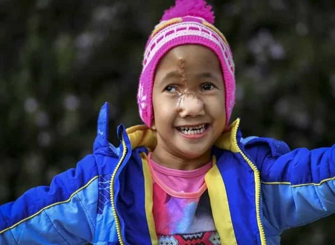 Pinay girl with deformed face gets life-changing surgery