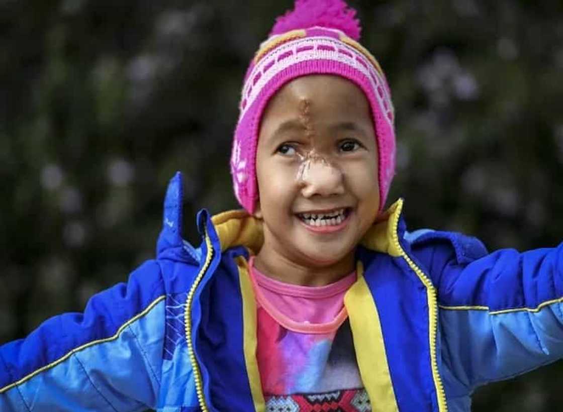 Pinay girl with deformed face gets life-changing surgery Pinay girl with deformed face gets life-changing surgery