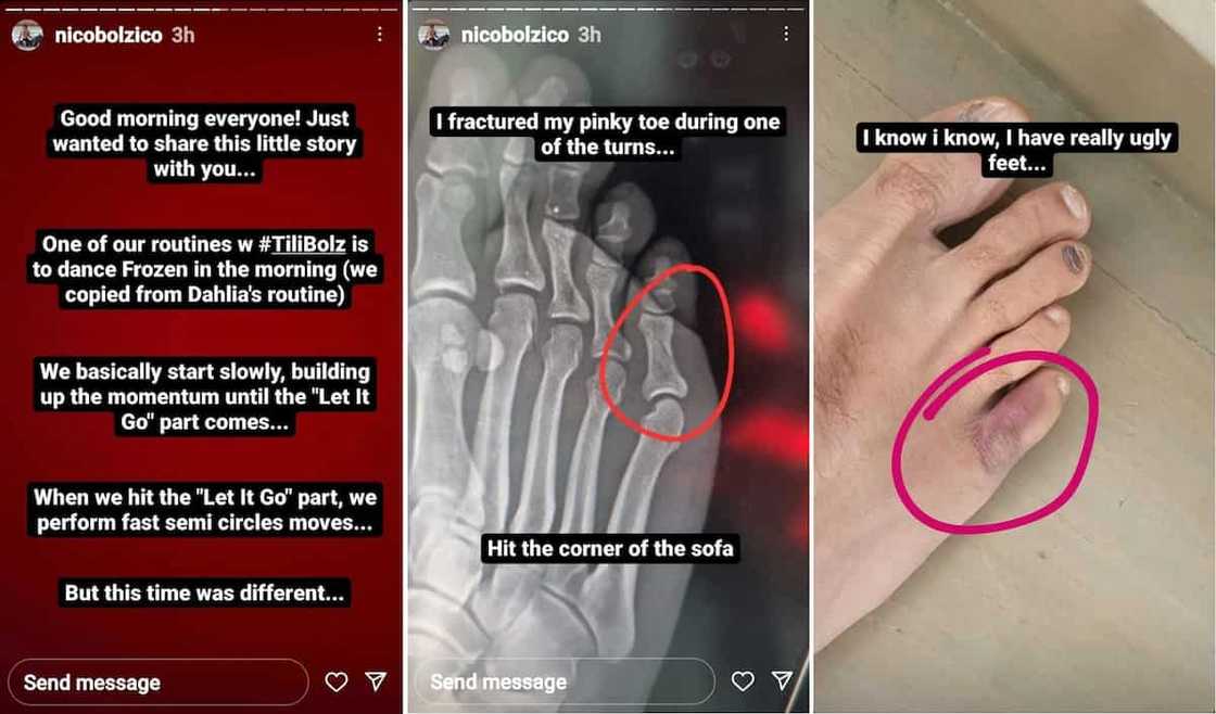 Nico Bolzico, na-fracture ang pinky toe habang sumasayaw kasama si baby Thylane Nico Bolzico, na-fracture ang pinky toe habang sumasayaw kasama si baby Thylane