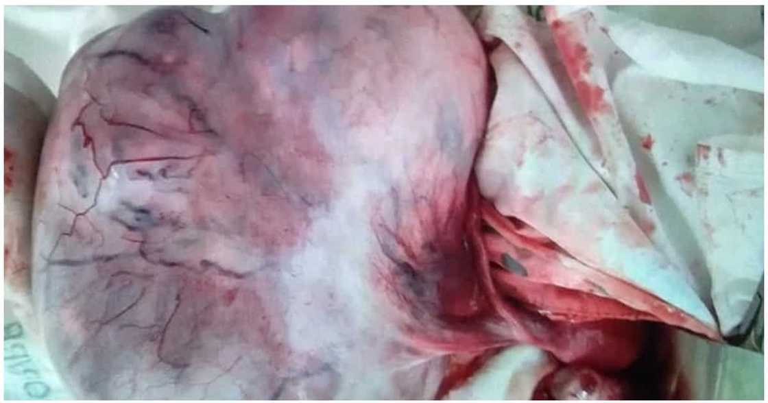 Ginang, nagbabala sa mga kapwa babae tungkol sa abnormal na paglaki ng tiyan Ginang, nagbabala sa mga kapwa babae tungkol sa abnormal na paglaki ng tiyan