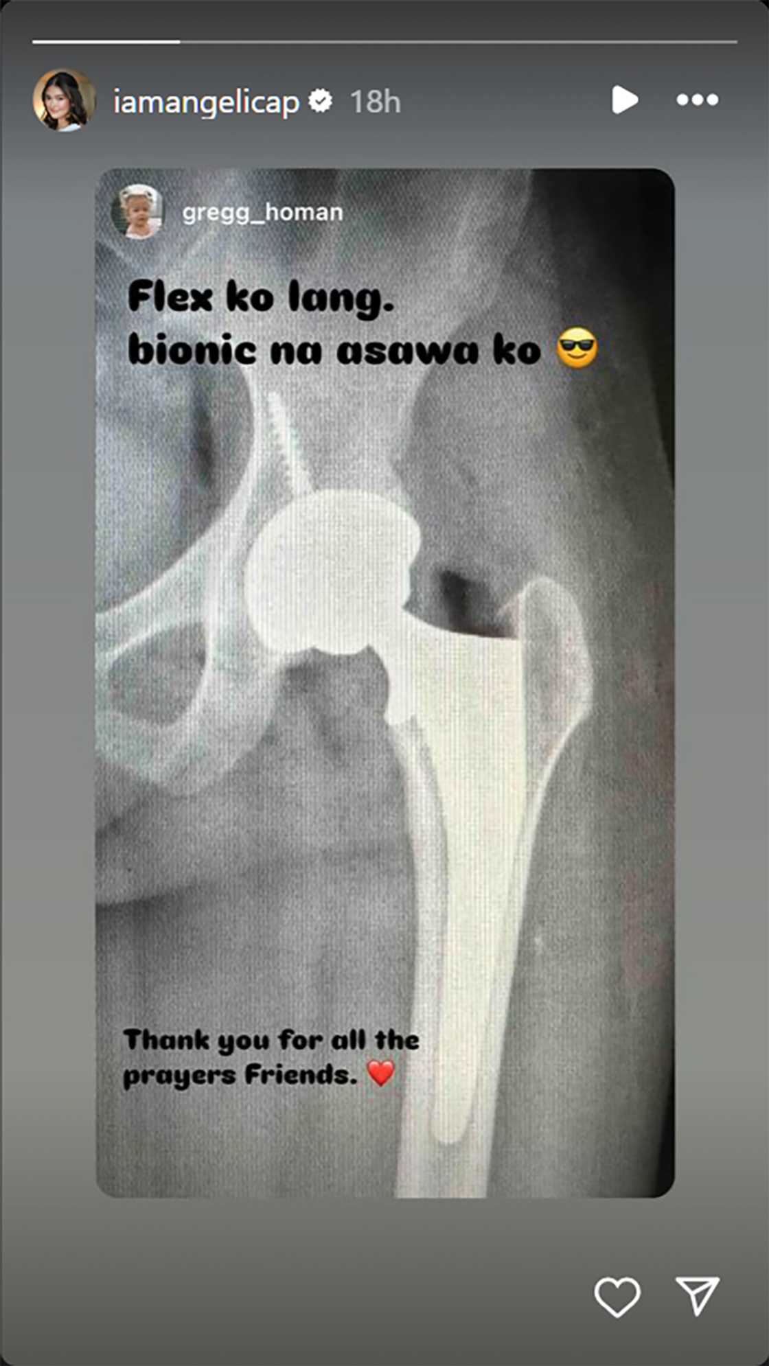 Gregg Homan, tinawag ang asawing si Angelica Panganiban na “bionic” Gregg Homan, tinawag ang asawing si Angelica Panganiban na “bionic”