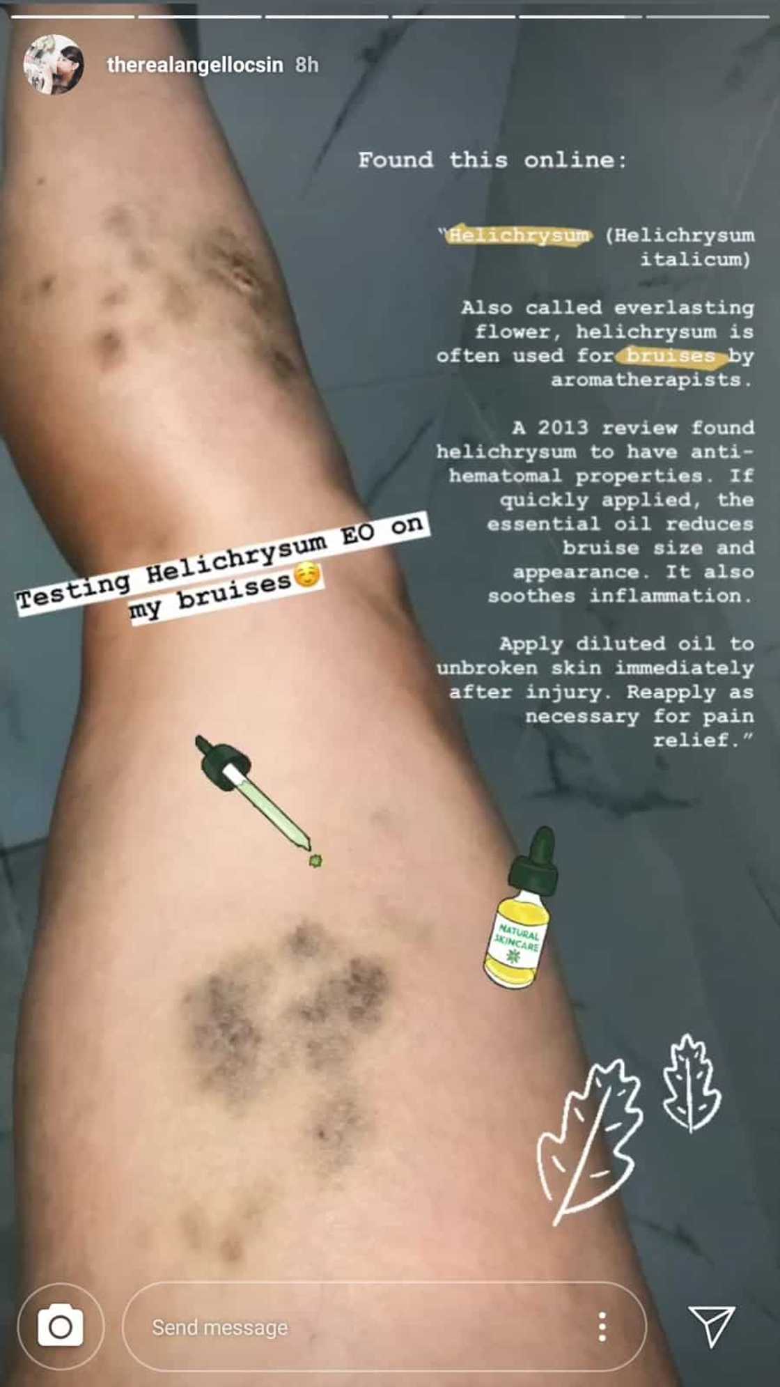 Angel Locsin, ipinakita ang kanyang mga pasa sa katawan; netizens, nag-alala Angel Locsin, ipinakita ang kanyang mga pasa sa katawan; netizens, nag-alala