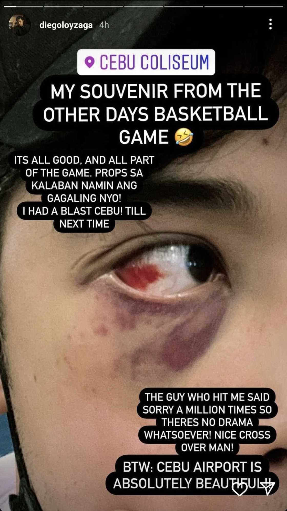 Diego Loyzaga, ipinakita ang naging "souvenir" niya mula sa basketball game Diego Loyzaga, ipinakita ang naging "souvenir" niya mula sa basketball game