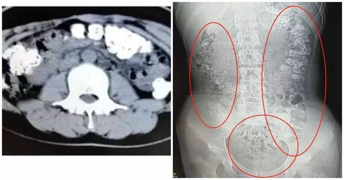 Babae, sumakit at namaga ang tiyan na hinihinalang dahil sa ininom na milk tea Babae, sumakit at namaga ang tiyan na hinihinalang dahil sa ininom na milk tea