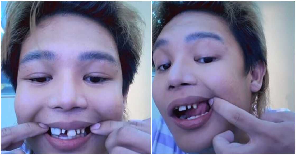 Xander Arizala, humingi ng tulong para sa pagpapaayos ng ngipin Xander Arizala, humingi ng tulong para sa pagpapaayos ng ngipin