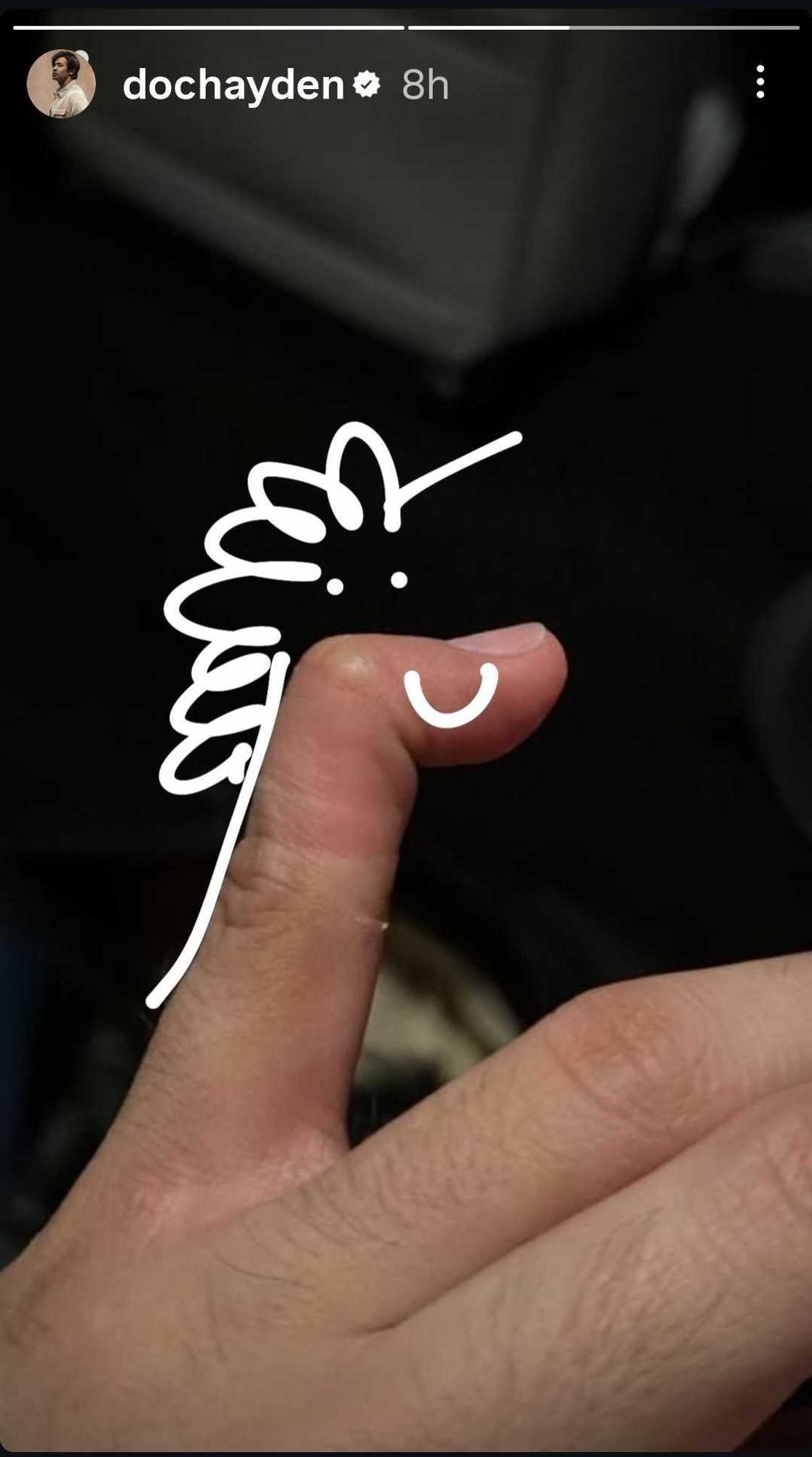 Hayden Kho, nagtamo ng injury matapos maglaro ng basketball (Photo: @dochayden) Hayden Kho, nagtamo ng injury matapos maglaro ng basketball (Photo: @dochayden)