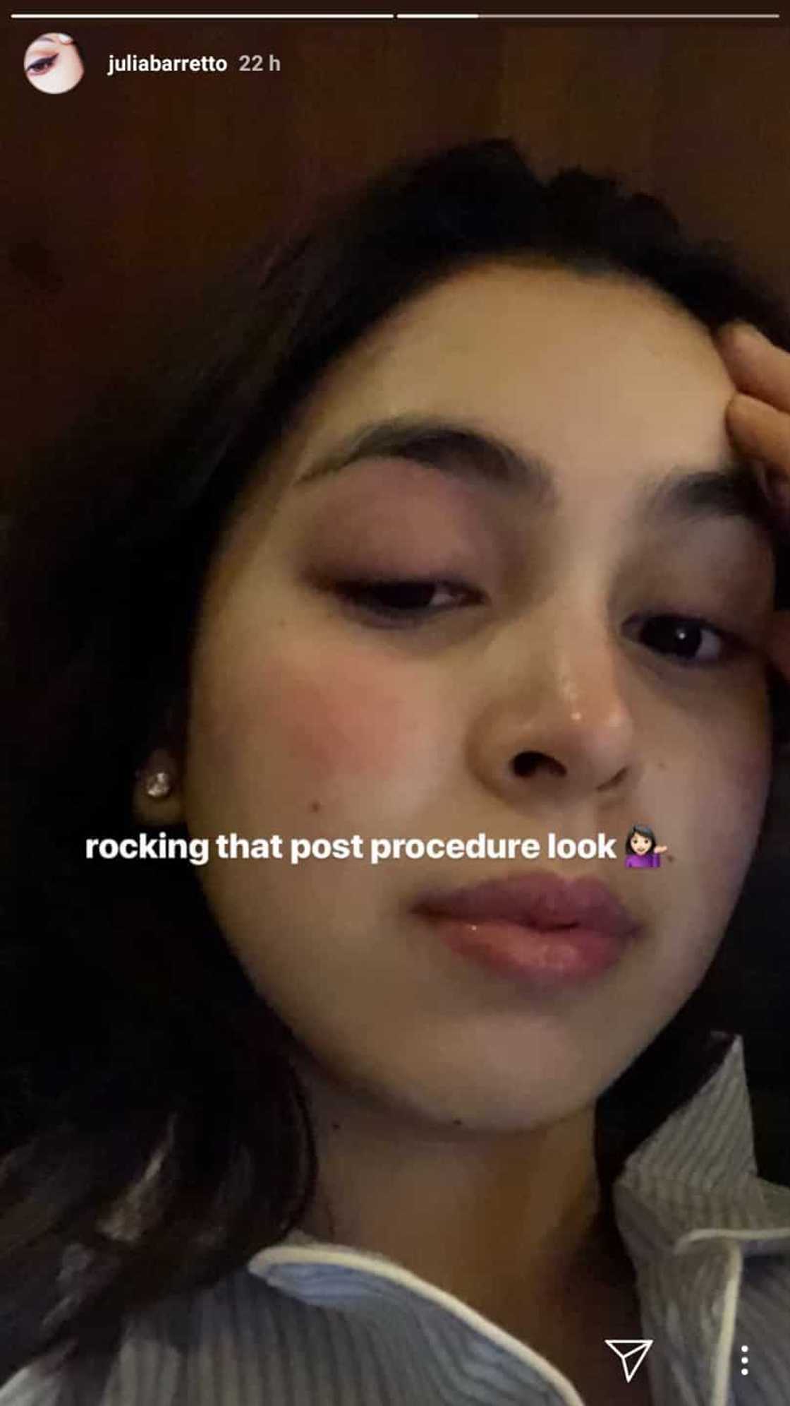 Julia Barretto posts post eye operation photos Julia Barretto posts post eye operation photos