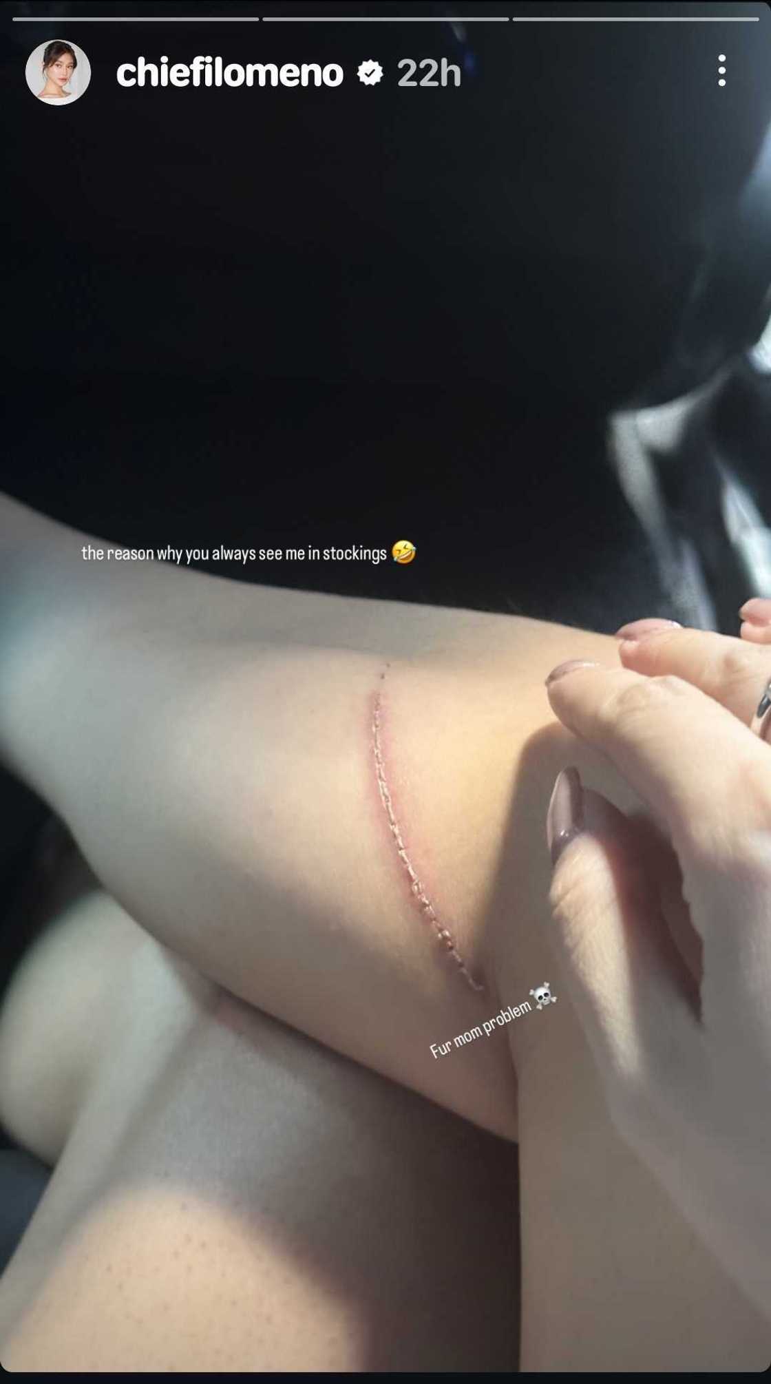 Chie Filomeno, ibinahagi ang dahilan ng malaking sugat niya sa binti