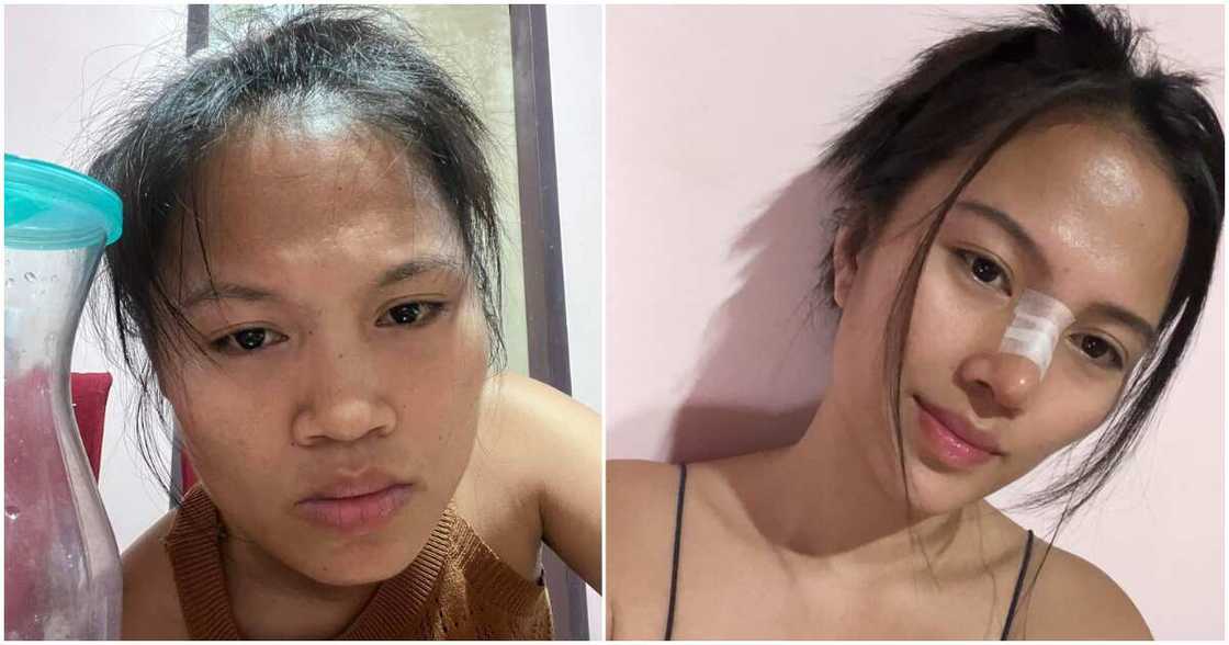 Teacher Dan, ibinida ang kanyang glow up matapos magpa-rhinoplasty