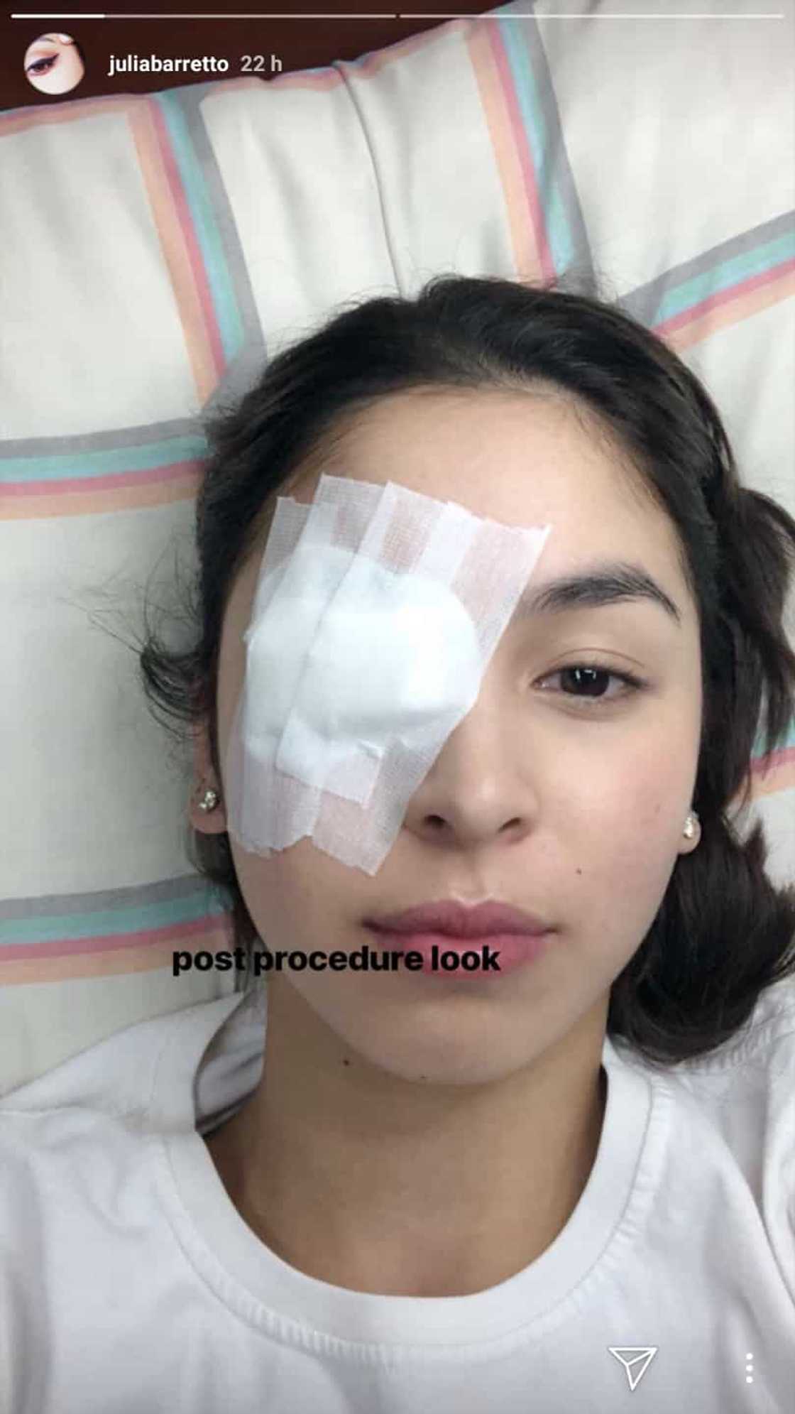 Julia Barretto posts post eye operation photos