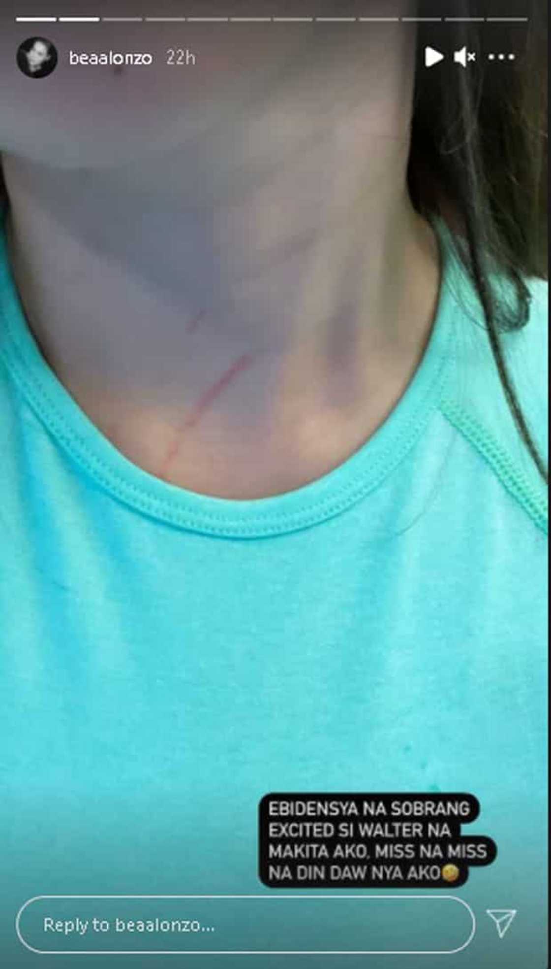 Bea Alonzo, ipinakita ang na-scratch ng aso niya sa leeg niya: "Miss na miss niya ako" Bea Alonzo, ipinakita ang na-scratch ng aso niya sa leeg niya: "Miss na miss niya ako"