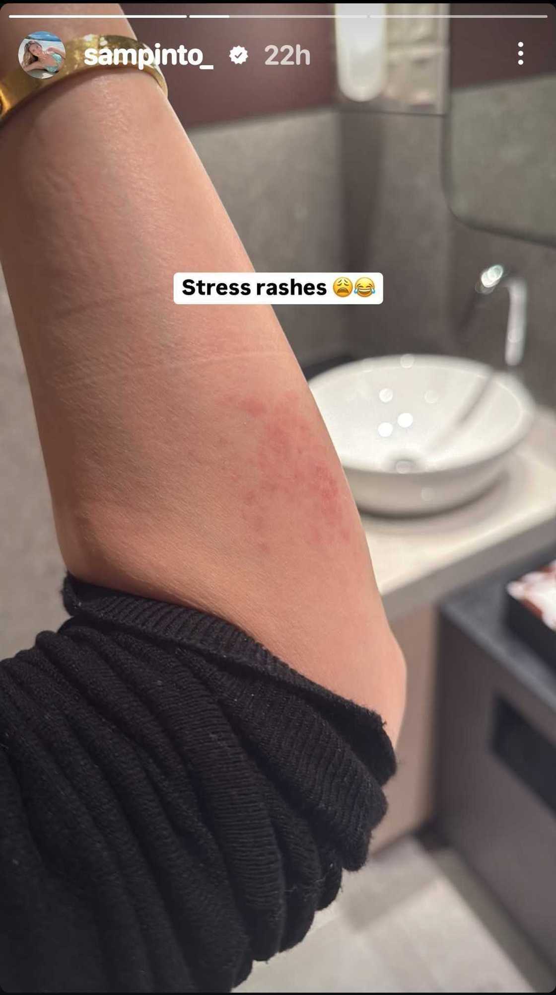 Sam Pinto, ipinakita ang “stress rashes” niya matapos isugod si Anthony Semerad sa hospital