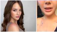 Ellen Adarna, ipinatanggal ang implants sa kanyang dibdib: "I can now breathe properly"