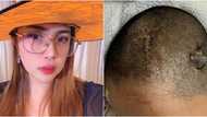 Businesswoman, nakaramdam ng matinding sakit ng ulo na humantong sa pagputok ng ugat sa utak