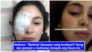 Julia Barretto posts post eye operation photos