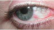 Tag-init alert! Sore eyes, mas mabilis kumalat sa panahong ito