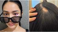 MUPH 2025 bet from Baguio suffered from alopecia, infection days before finals