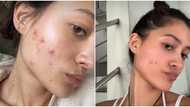 Maureen Wroblewitz bravely shares struggles with acne, insecurity
