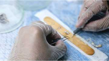 38-anyos na lalaki, namatay matapos sumailalim sa hair transplant procedure