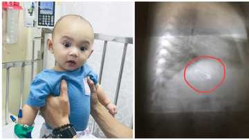 Isang sanggol, aksidenteng nakalunok ng perdible