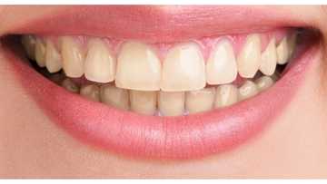 Lalaki sa Pampanga, nalunok ang brace wire habang kumakain ng rice cake