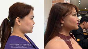 Baninay Bautista, ipinakita ang kanyang bagong side profile matapos ang cosmetic procedure