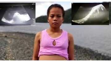 Buntis, hinihinalang isda ang laman ng tiyan dahil sa nakita sa ultrasound