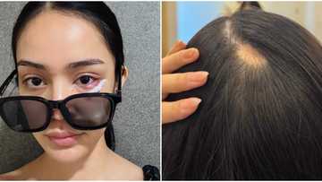 MUPH 2025 bet from Baguio suffered from alopecia, infection days before finals