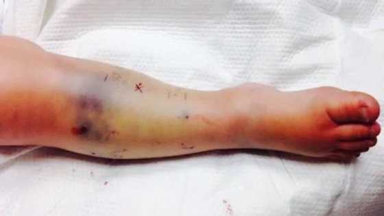 Shocking: 2-year-old child was bitten by this dangerous creature!