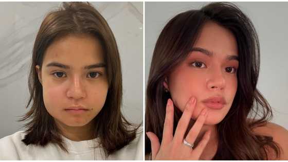 Maris Racal shares photos of her with swollen cheek: “I am okay now”