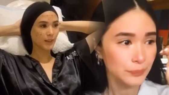 Heart Evangelista, inoperahan dahil sa "developing" cyst sa kanyang mukha