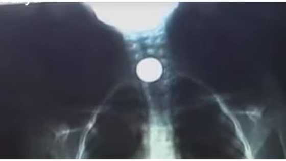 9-anyos na batang babae, nakalunok ng piso na pinaglaruan nito