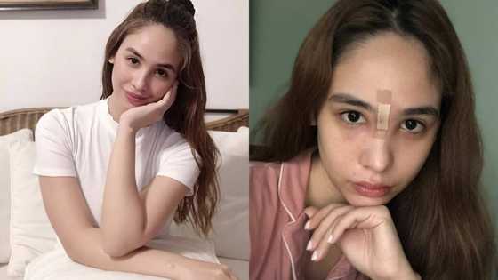 Empress Schuck warns netizens about the dangers of squeezing and popping a pimple