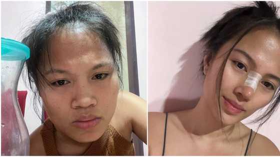 Teacher Dan, ibinida ang kanyang glow up matapos magpa-rhinoplasty