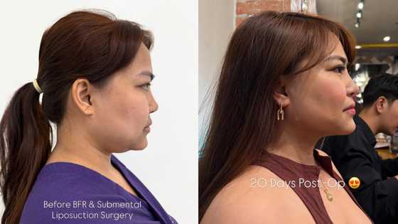 Baninay Bautista, ipinakita ang kanyang bagong side profile matapos ang cosmetic procedure