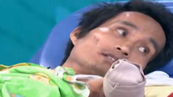 Nakapanlulumo! Sekyu, putol 2 kamay, naging inutil, dahil sa aksidente sa trabaho, di tinulungan ng agency
