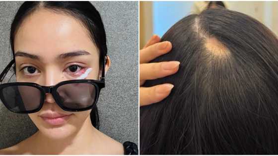 MUPH 2025 bet from Baguio suffered from alopecia, infection days before finals